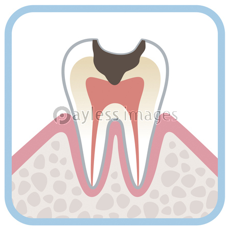 歯の断面図 虫歯 ストックフォトの定額制ペイレスイメージズ